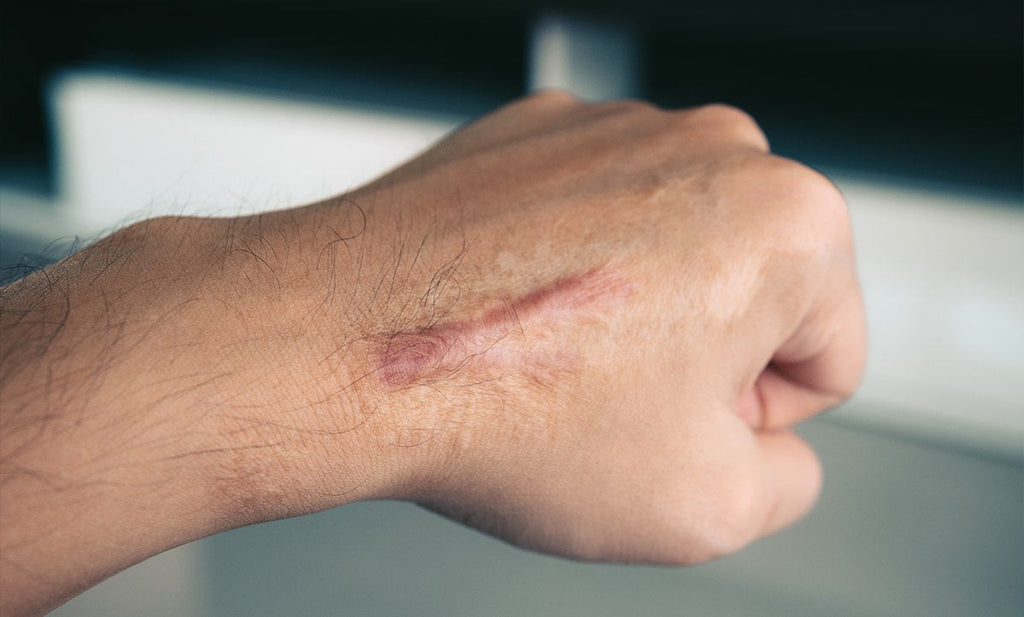 How to Prevent Scarring During Wound Healing